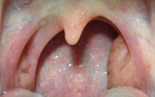 Способы диагностики и лечения кисты нёбной миндалины