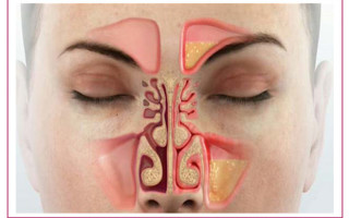 Методика промывания носа лечебными растворами