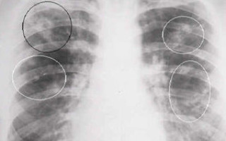 Заразна ли туберкулома лёгких и каковы последствия?
