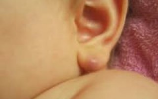 Шишка на мочке уха чем лечить, как избавиться от уплотнения