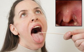 Казеозные пробки в горле (на лакунах миндалин): причины и лечение