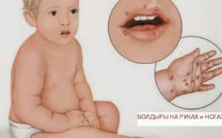 Симптомы вируса Коксаки у детей и взрослых