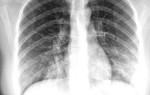 Пневмония на рентгене: признаки болезни на рентгеновских снимках