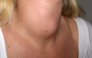 Увеличение щитовидки: причины, симптомы, лечение