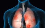 Пневмония — воспаление лёгких без температуры у взрослых, симптомы