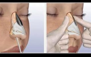 Репозиция костей носа после перелома
