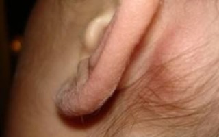 Как лечить воспаление лимфоузлов за ухом?