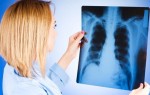 Как лечиться от туберкулеза: можно ли излечиться