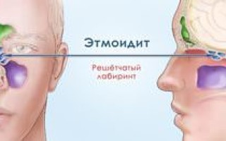 Симптомы и лечение этмоидита и гаймороэтмоидита