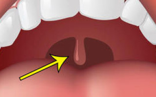 Отечность небного язычка в горле и от чего он может увеличиваться