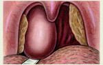 Абсцесс горла: симптомы и эффективное лечение