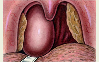 Абсцесс горла: симптомы и эффективное лечение