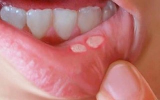 Стафилококк во рту: симптомы, способы лечения, фото