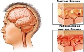 Главные признаки серозного менингита