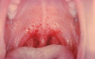 Сыпь в горле: причины и лечение