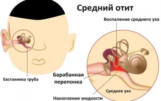 Острый и хронический отит среднего уха: лечение и причины патологии