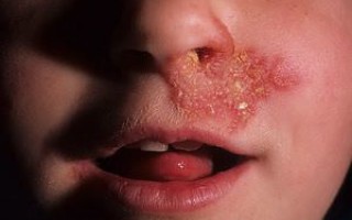 Чем мазать болячки в носу: причины их появления и лечение