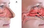 Гной в носу, симптомы и лечение