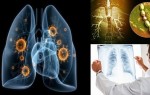 Туберкулезная болезнь: борьба с туберкулезной бактерией, палочкой Коха