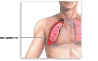 Вода в лёгких: причины, последствия, лечение