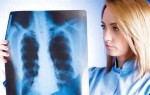 Туберкулез: как он может передаваться, пути передачи и симптомы