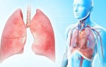 Что это такое внебольничная пневмония: возбудители и лечение