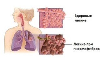 Все о фиброзе легких: как лечить фиброзные изменения в легких
