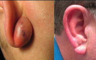 От чего образуется шишка на мочке уха?