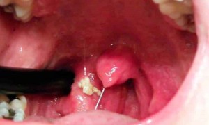 Белые комочки в горле: причины и лечение