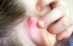 Причины увеличения лимфоузлов за ушами