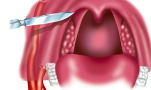 Абсцесс в горле — что это, типы, симптомы и лечение