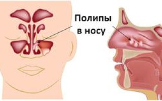 Полипоз носа: симптомы и лечение