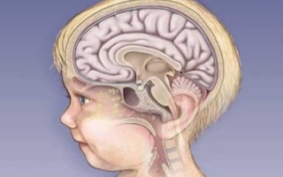 Основные признаки серозного менингита у ребенка