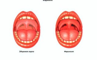 Красная задняя стенка горла: причины и лечение