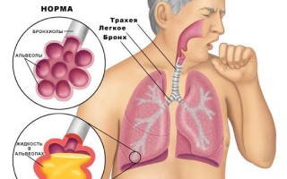 Первые признаки пневмонии у детей как распознать, в чем выражается болезнь