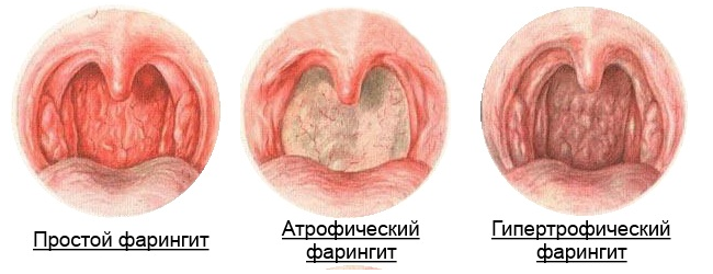 стадии фарингита