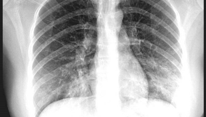 атипичная пневмония на рентгене