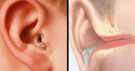 Тонзиллит и отит среднего уха