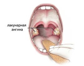 Тонзиллит при ангине