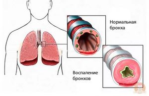 В чем опасность спазмов бронхов