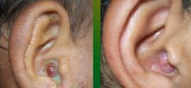 Закладывает ухо при насморке – что делать, причины и лечение