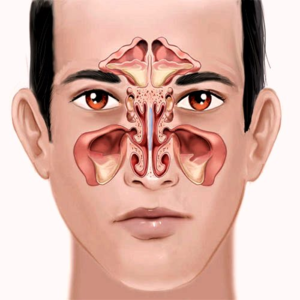 Воспаление пазух носа