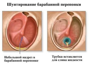 Шунтирование ушей - особенности процедуры