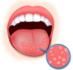 Кандидоз или пузырьки в горле