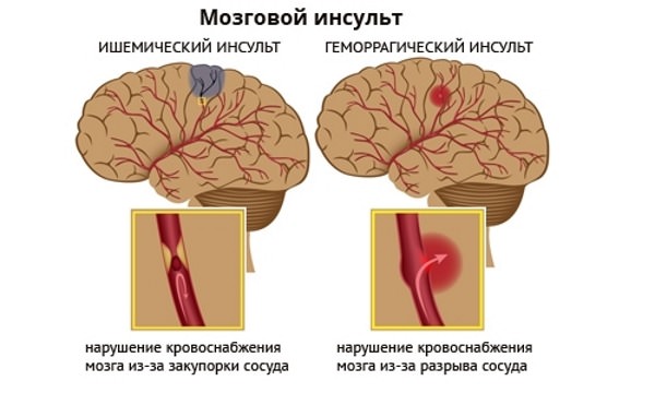 Инсульт мозга