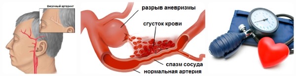 Височный артериит