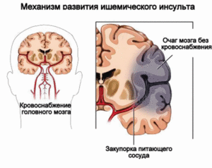 Как проходит ишемический инсульт головного мозга