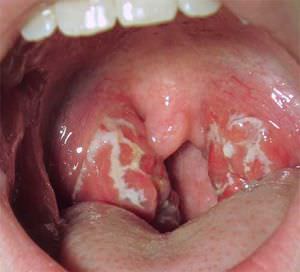 Тонзиллит - воспаление небных миндалин