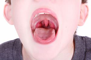 Как вылечить ребенку красное горло
