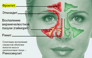 Описание воспалительного заболевания носовой полости риносинусита